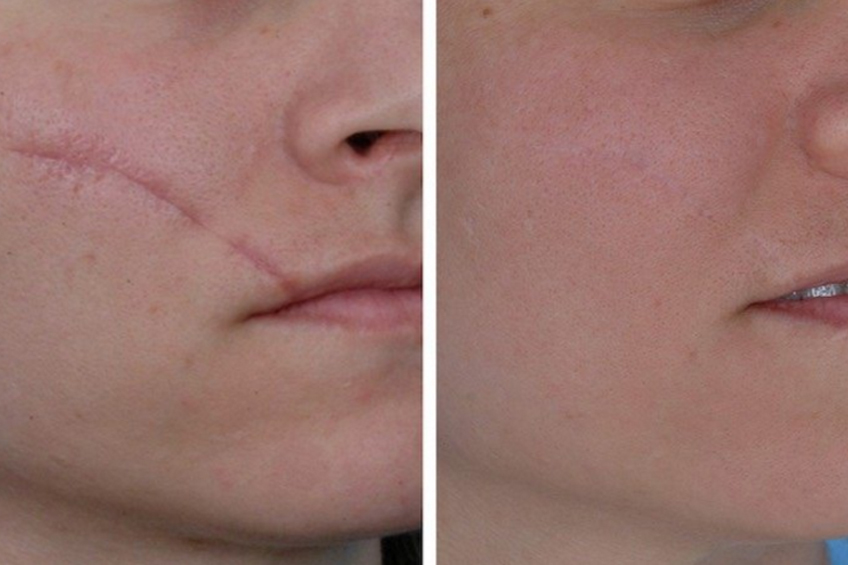scar removal